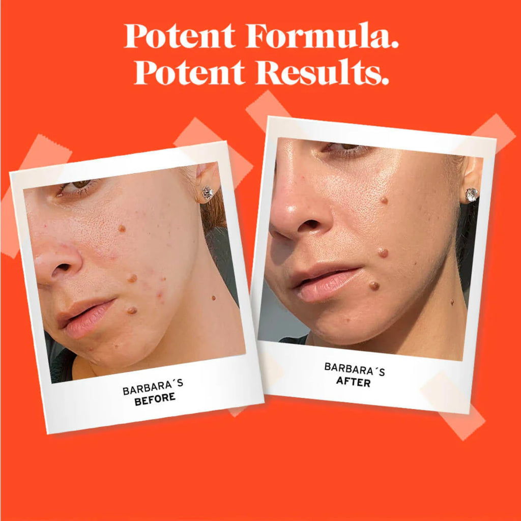 No Bad Stuff - Acne Spot Treatment - Acne Control with 2% Salicylic Acid, Fades Blemishes, with Chamomile, Aloe Vera & Vitamin E (0.5 oz)