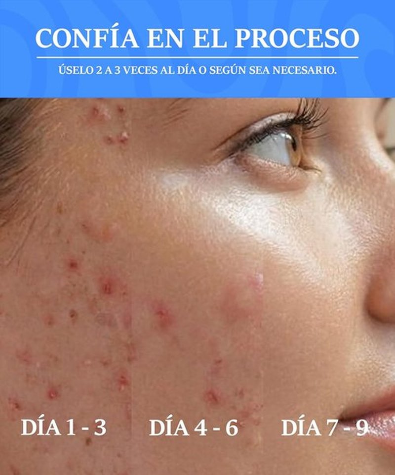 Skiennix Skin Recovery Mist - Hypochlorous Acid Face & Body Spray for Acne & Redness - 5.07 fl oz