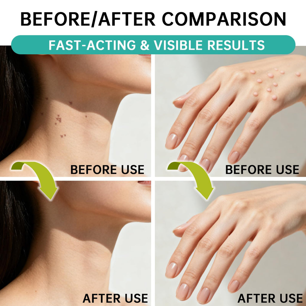 SERYNTH Salicylic Acid Wart Remover Liquid Freeze Off, Quickly Removes Plantar Warts, Corn Warts, and Finger Warts. Maximum Strength Formula - 17%, Painless & Safe, Effective, Scar-Free Solution.