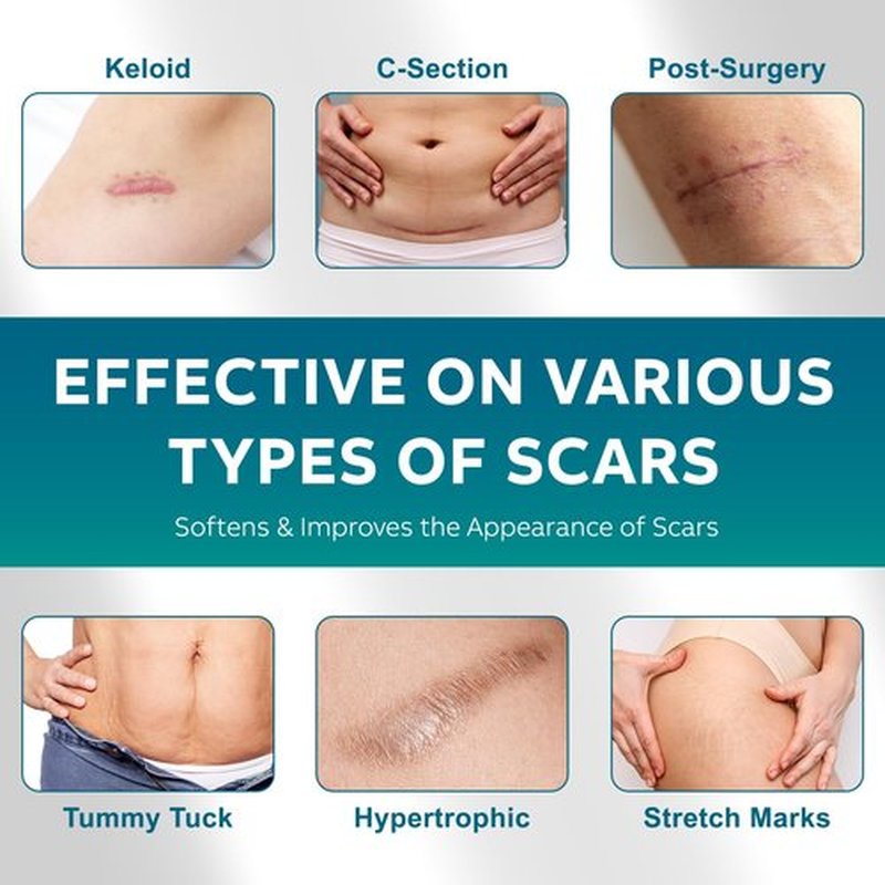 Silicone Scar Sheets, Silicone Scar Tape(1.6"x 120" Roll-300CM), Silicone Tape for Scars, Scar Tape for Surgical Scars, Silicone Scar Strips for C-Section, Tummy Tuck, Keloid, and Surgical Scars