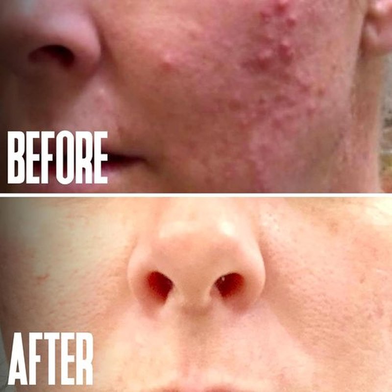 Alpha Hydroxy Acid | Glycolic Acid Peel 40% - Professional Exfoliant for Acne Scars & Wrinkles