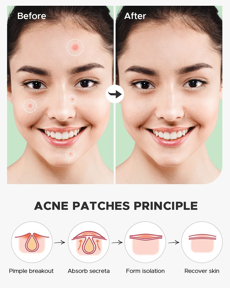 ZATKTK Pimple Patch (360 Counts 4 Sizes), Hydrocolliod Acne Patch for Face, Invisible Zit Patch with Tea Tree Oil & Calendula Oil, Blemish Patch