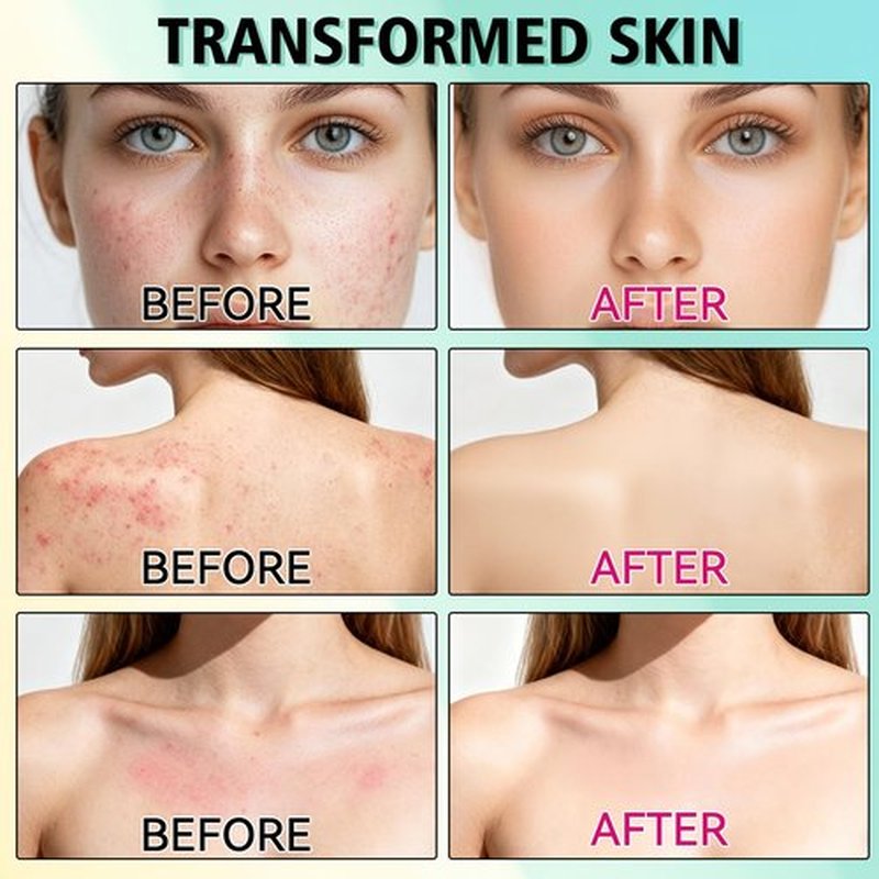 Acne Treatment for Face, Acne Cream, Pimple Cream Suitable for All Skin, Blemish Care Cream for Face and Body, Gentle Daily Skin Care for Oily & Blemish-Prone Skin, Helps Improve Skin Appearance