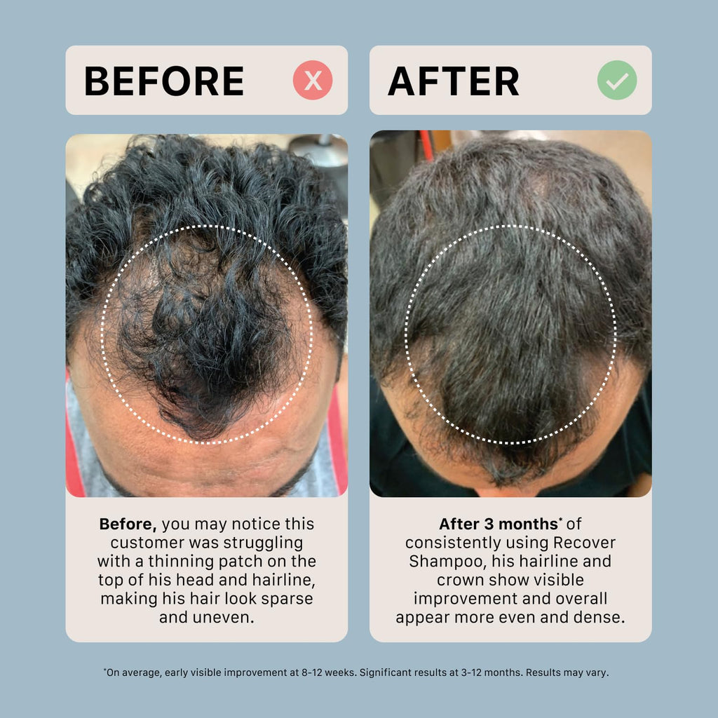 ACTIIV Recover Thickening Shampoo Treatment For Men | Fuller Hair, 16 Fl Oz