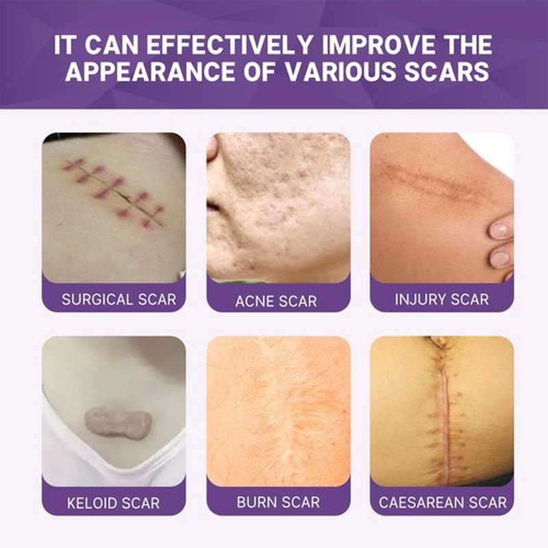 Scar Soothing Cream,Scar Cream,Advanced Scar Removal Cream for Surgical Scars, 3% Dimethicone Complex Silicone scar cream for Old & New Scars,C-Section, Pregnancy, Acne, Injury, Keloids, Burns (1PCS)
