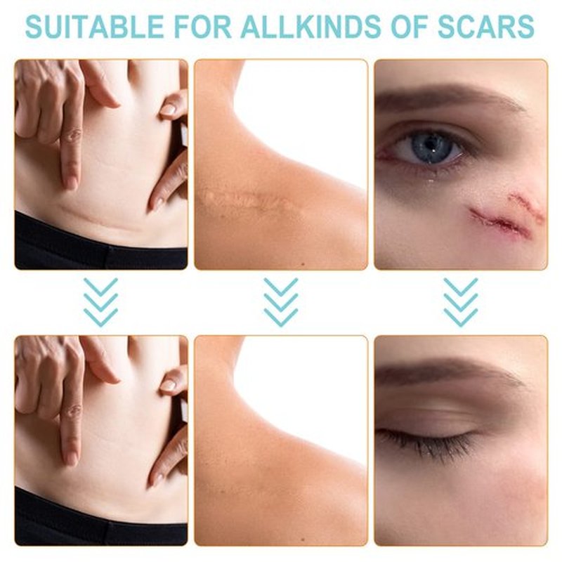 Silicone Scar Sheets (1.6” x 150”-3.8M), Medical Grade Soft Silicone Scar Tape, Scar Strips, Scar Roll - Keloid, C-Section, Surgical, Acne- Scars Removal Treatment, Painless Easy Removal, Reusable