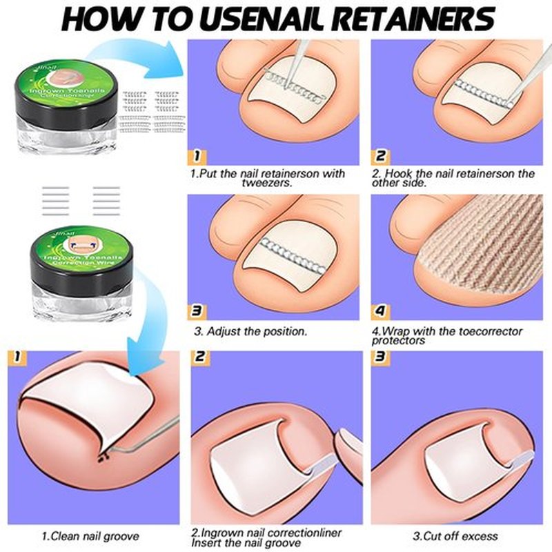Ingrown Toenail Removal Kit, Ingrown Toenail Tool with Ingrown Toenail Strips, Curved Toenails Corrector Patch, Painless File and Lifter, Ingrown Nail Correction Home Care for Men and Women.