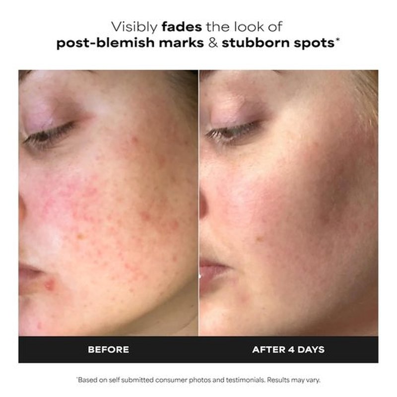 Paula's Choice BOOST 10% Azelaic Acid Gel Serum - Oil-Free, Skin Brightening, Fragrance-Free