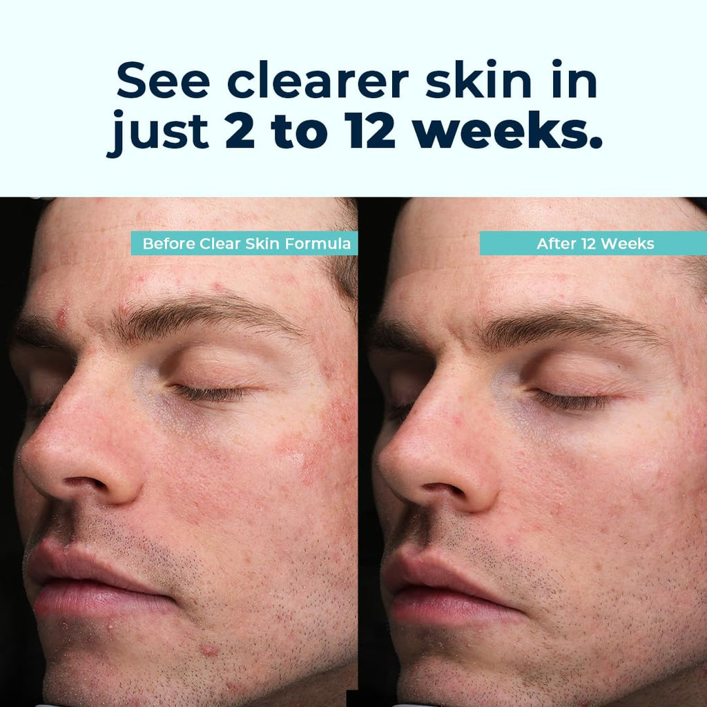 VitaMedica Clear Skin Vitamin Formula | Noncystic Acne Supplement for Skin Clearing | Clear Complexion for Women and Men | Vitamins A, C, E, Selenium, Chromium, and Zinc for Skin Health | 60 Count