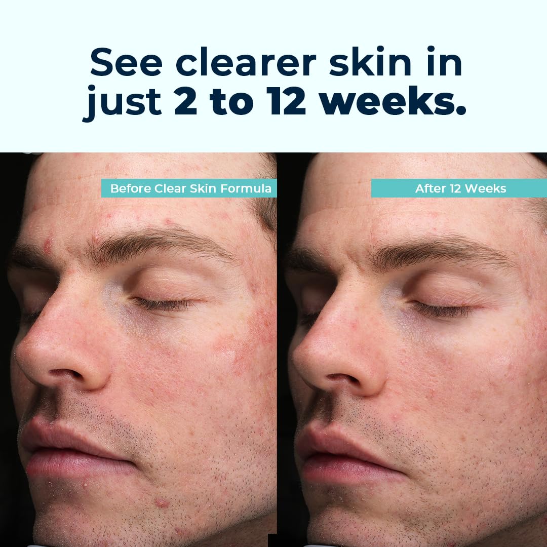 VitaMedica Clear Skin Vitamin Formula | Noncystic Acne Supplement for Skin Clearing | Clear Complexion for Women and Men | Vitamins A, C, E, Selenium, Chromium, and Zinc for Skin Health | 60 Count
