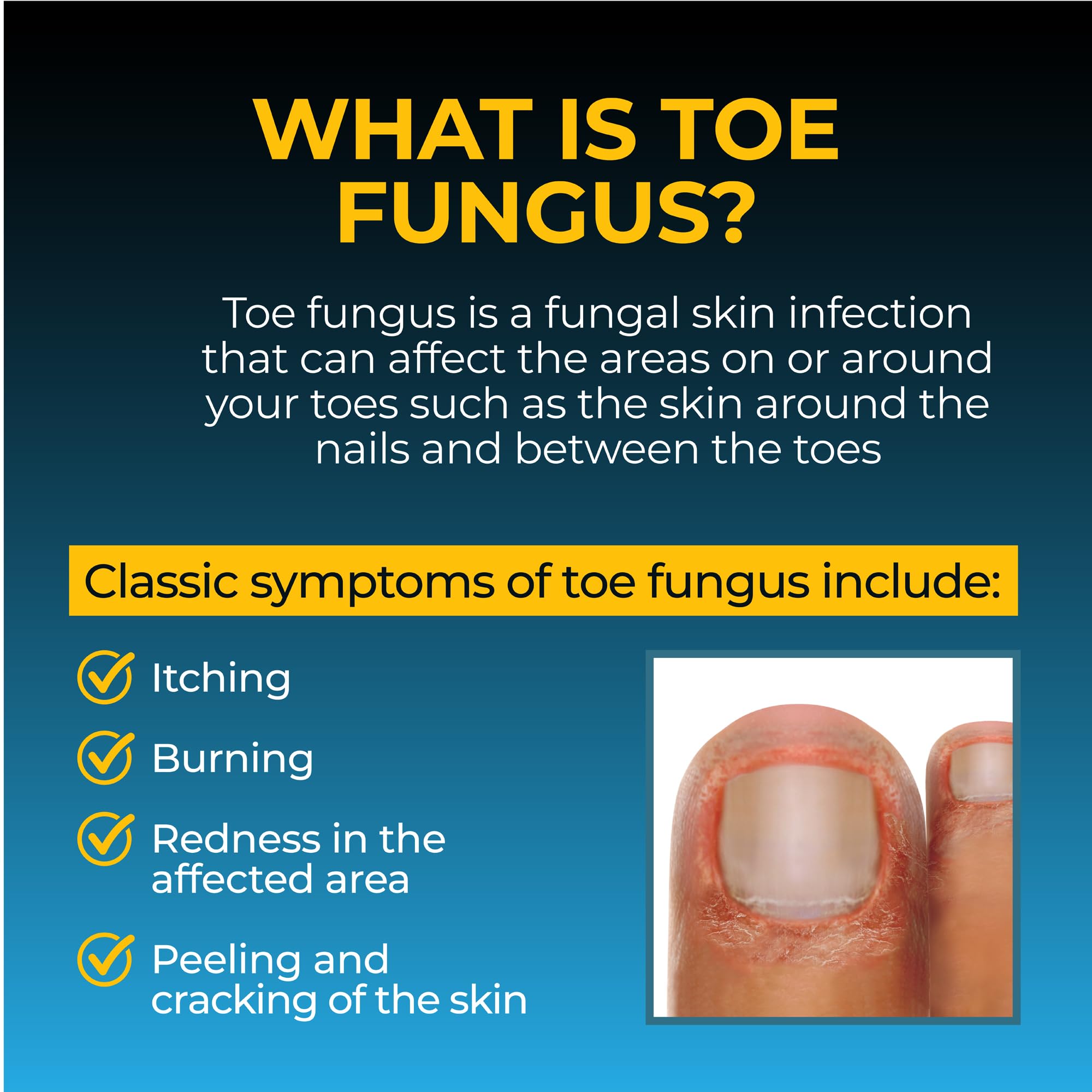 Fungi-Nail Anti-Fungal Liquid Solution, Kills Toe Fungus and Tolnaftate & Clincially Proven to Cure and Prevent Fungal Infections, 1 Oz (Pack of 1)