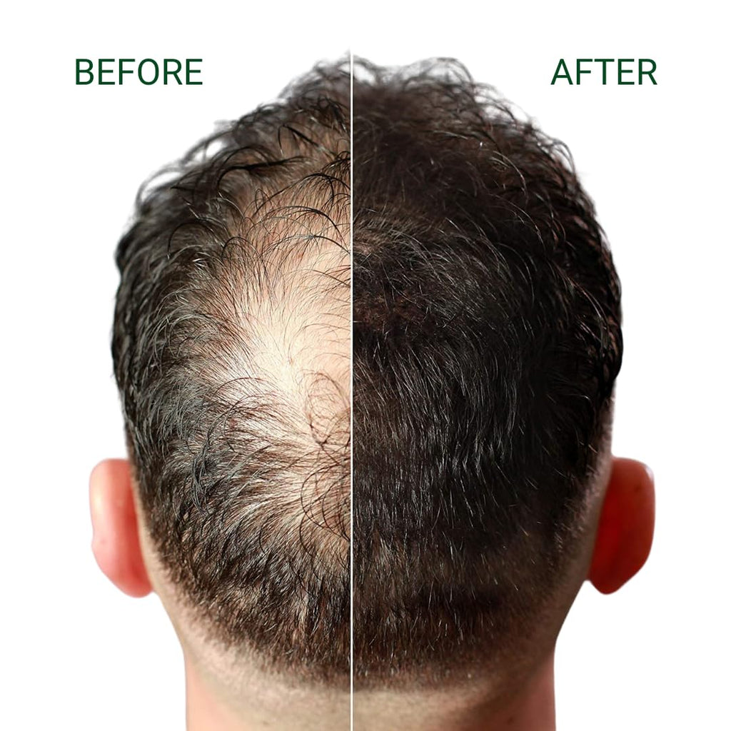 FIBR Hair Keratin Building Fibers, Fill In Fine and Thinning Hair for instant Full and Thick Look, Premium Hair Fibers For Both Men and Women (Blonde)