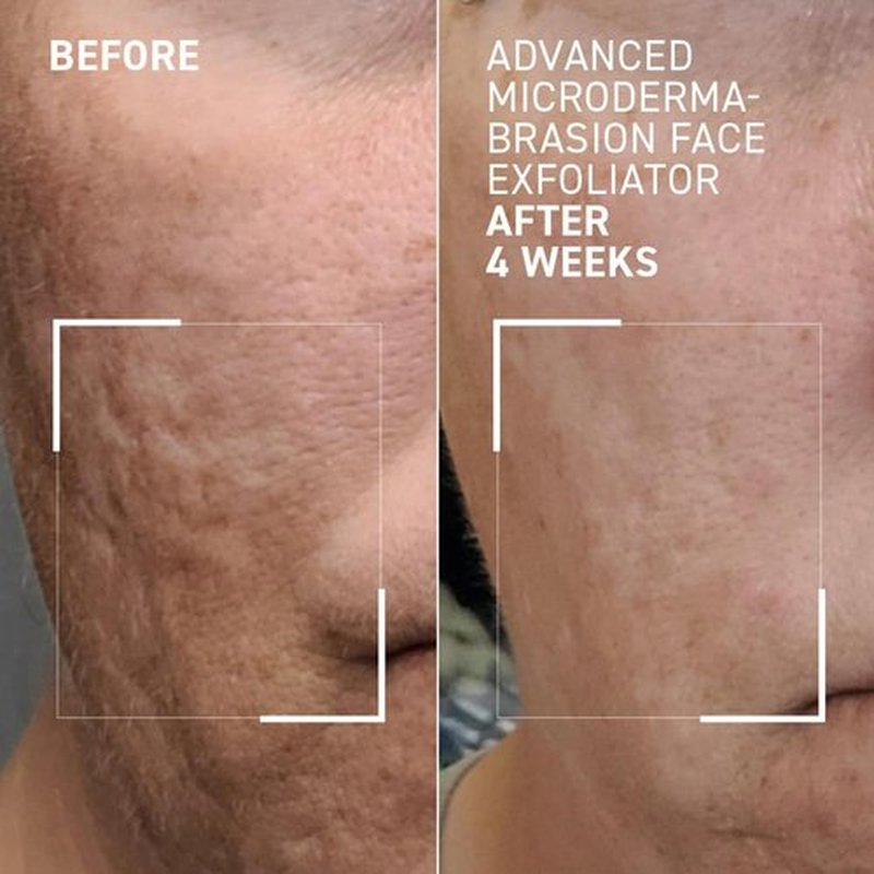 Dr. Brandt Microdermabrasion Exfoliator - Travel Size 0.7 oz | Refines Texture & Minimizes Fine Lines