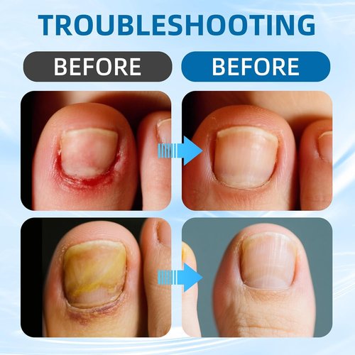 Ingrown Toenail Corrector Set with Correction Strips, Professional ingrown toenails pedicure tool set for men and women (1 SET)