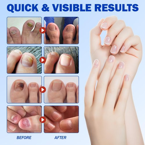 Nail Treatment Patches, 21 Pcs Discolored Thickened Nails Repair, 8 Hour Nightime Nail Renewal Waterproof for men women