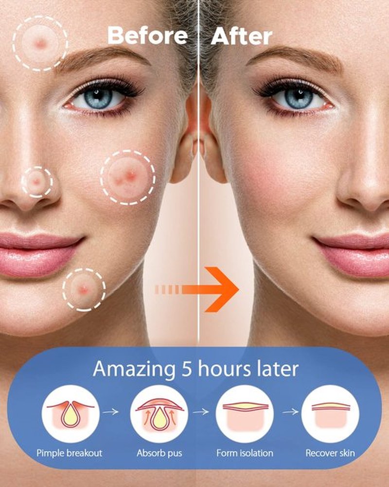 LitBear Acne Pimple Patches- Day and Night 4 Sizes 360 Dots Thin & Thick Hydrocolloid Patches with Witch Hazel, Tea Tree & Calendula Oil, Extra Adhesion Pimple Patches for Face Zit Patch Acne Dots