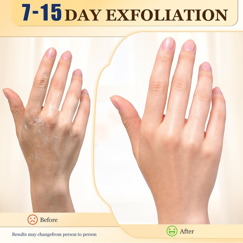 Z:SEA Repairing Hand Masks 5 Pack, Moisturizing Gloves for Dry Hands with Shea Butter, Niacinamide, Meadowfoam Seed Oil, Vitamin E, Repairs & Softens Rough Skin, Reduce Wrinkles & Hangnails
