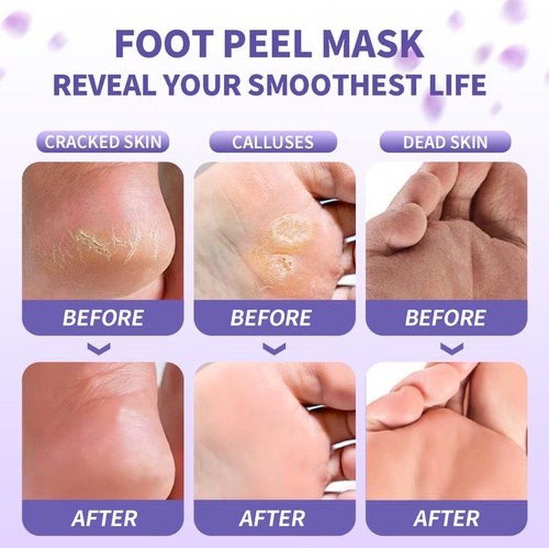 Foot Peeling Mask 5 Pairs - Foot Mask for Dry Cracked Feet, Feet Peeling Masks that Remove Dead Skin for Soft Heels (Lavender)