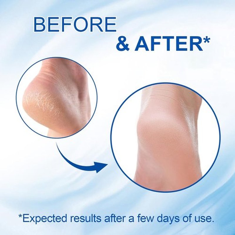 **Regine Switzerland 60% Urea Cream Stick - Maximum Strength Foot Cream for Dry Cracked Heels | Rapid Callus Remover**