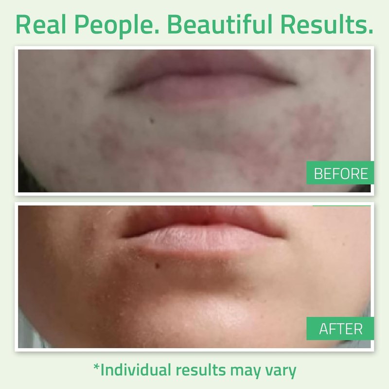 YEOUTH Glycolic Acid Peel - At-Home Chemical Exfoliator with 30% AHA & Retinol | 1oz for Smooth Skin