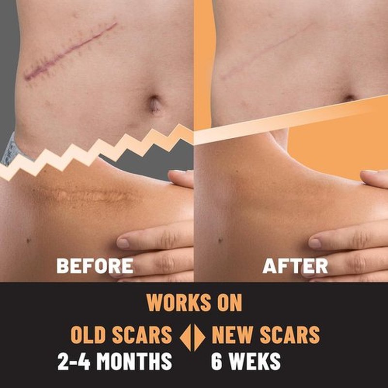 TOLEVITA Silicone Scar Patches – Silicone Gel Sheets for Scars, Acne, Surgery, Keloid, Scar Removal and Stretch Marks – Gentle Scar Care & Fading - 5 Sheets