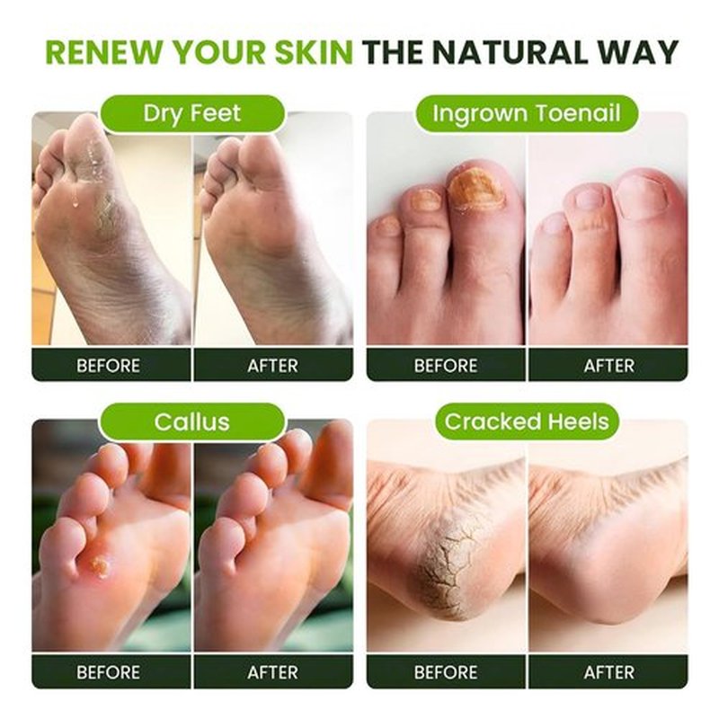 Tea Tree Oil Foot Soak by [Brand Name] - Epsom Salt Formula for Toenail Repair & Sore Feet Relief | 16 oz