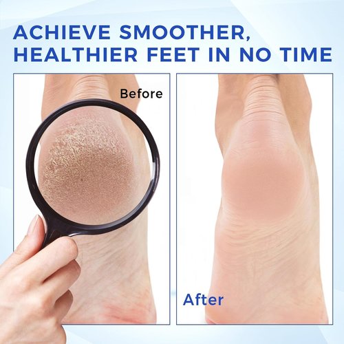 OUKEYA Urea Cream 40 Percent for Foot & Hand Cream with Foot Files for Dry Cracked,Urea Lotion for Feet Maximum Strength