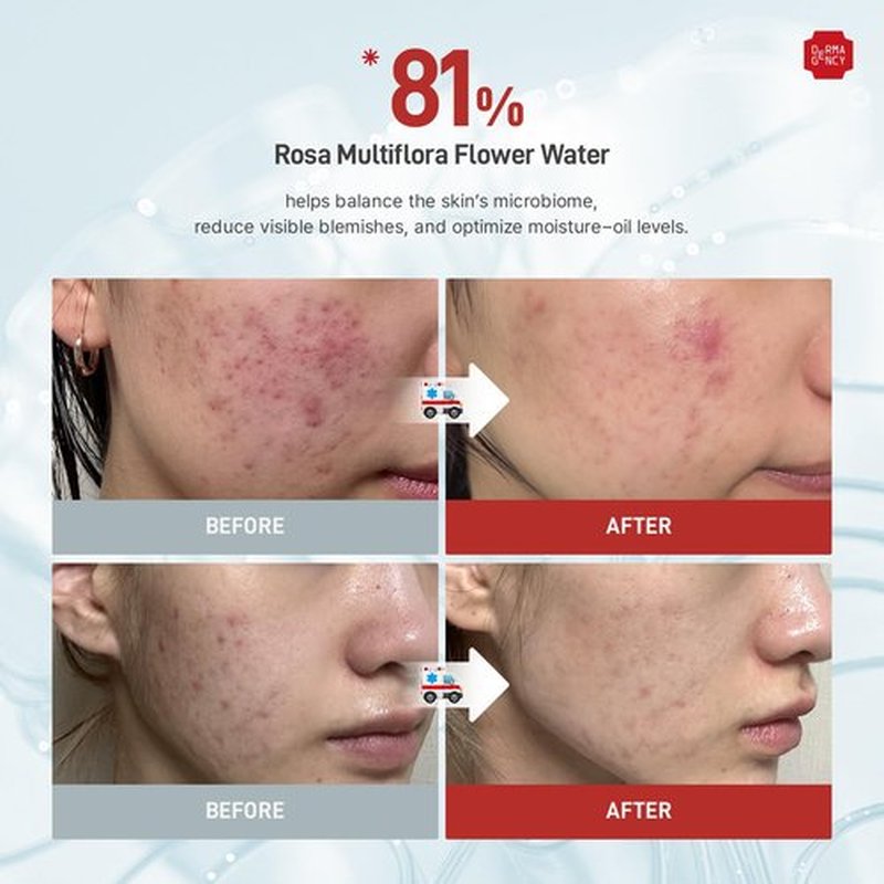DERMAGENCY Zeroca 81 Cream – Korean Wild Rose Moisturizer for Acne-Prone & Sensitive Skin, Controls Sebum, Lightweight Hydration for Smooth Texture | 60ml/ 2.02oz
