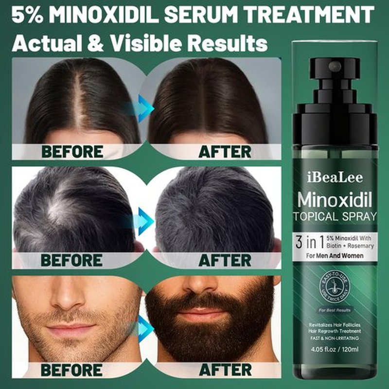 5% Minoxidil for Men and Women Hair Growth, Minoxidil Hair Growth Spray with Biotin & Rosemary to Fight Hair Loss, Extra Strength Hair Regrowth Treatments for Thicker Stronger Fuller Hair, 2 Bottles