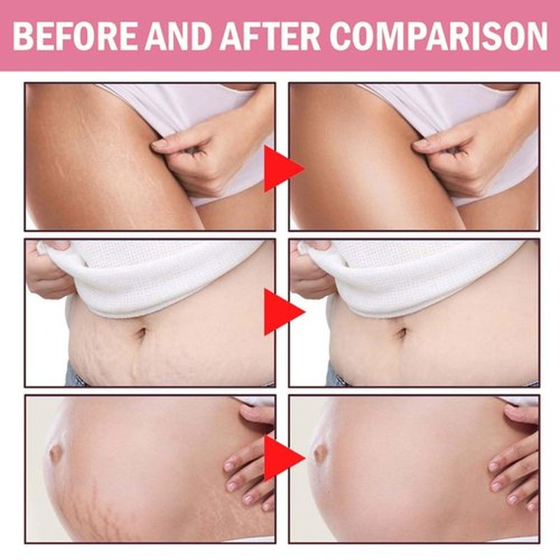 JINMAO Adeus Crema Brasileña – Intensive Multifunctional Body Treatment, Pink Stretch Mark Cream with Arnica, Ginger, Caffeine & Green Tea for Smooth, Elastic Skin – 300g