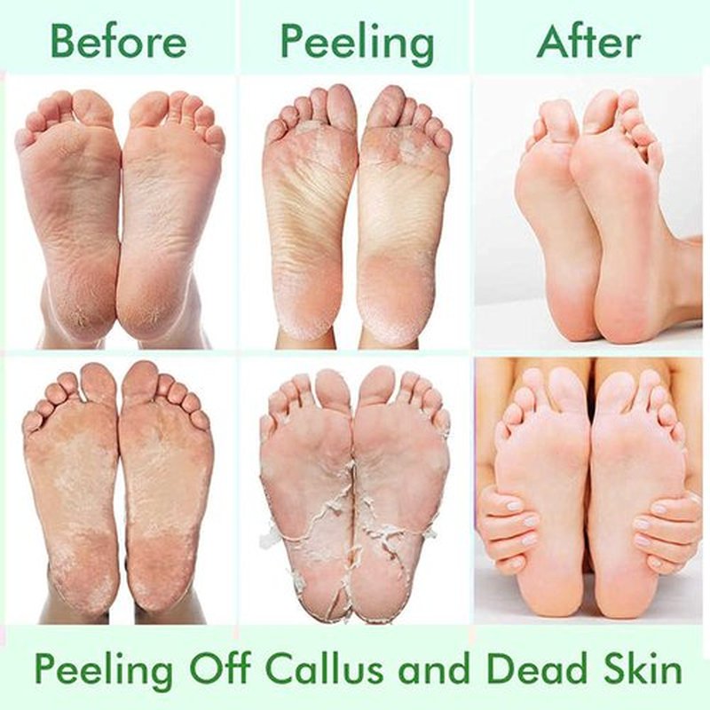 5 Pack Foot Peeling Mask,Exfoliator Peel Off Calluses Dead Skin Callus Remover,Foot Mask for Dry Cracked Feet,Foot Peel Masks for Men and Women Feet Peeling Mask for Valentines Day Gifts