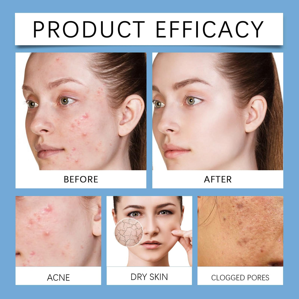Acne Set with Arctic Plant Ingredients, Night Balm, Day Balm, Face Scrub, Reduces Redness, Moisturize & Repair, All Skin Types