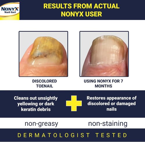 NONYX Fungal Nail Clarifying Gel - Clinically Proven Treatment for Discolored & Brittle Toenails | 90% Improvement Rate
