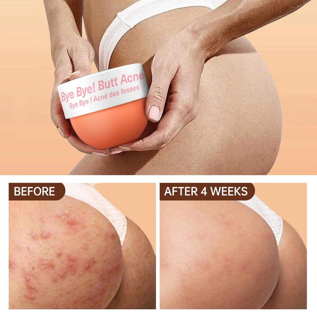 Butt Acne Clearing Treatment, Body Cream for Back, Buttocks, Thigh & Chest Acne, Skin Clearing Lotion for Men & Women 5.46 oz