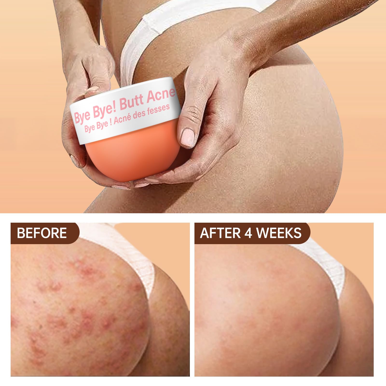 Butt Acne Clearing Treatment, Body Cream for Back, Buttocks, Thigh & Chest Acne, Skin Clearing Lotion for Men & Women 5.46 oz