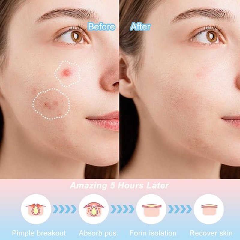 CELECARE Pimple Patches,Pimple Patches for Face,Hydrocolloid Acne Patches, Pimple Patch Cute, Salicylic Acid &Tea Tree Oil,8 Unique Acne Patch Designs,148 Count