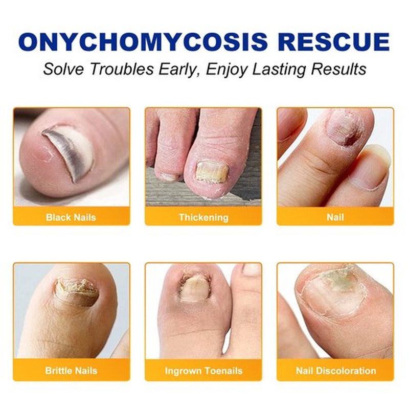 Toenail Treatment Extra Strength-8-Hrs Overnight Nail Repair,ingrown toenail treatment,Strengthens Brittle Nails,Improves Texture & Thickening Hypoallergenic Easy (64 Patch)