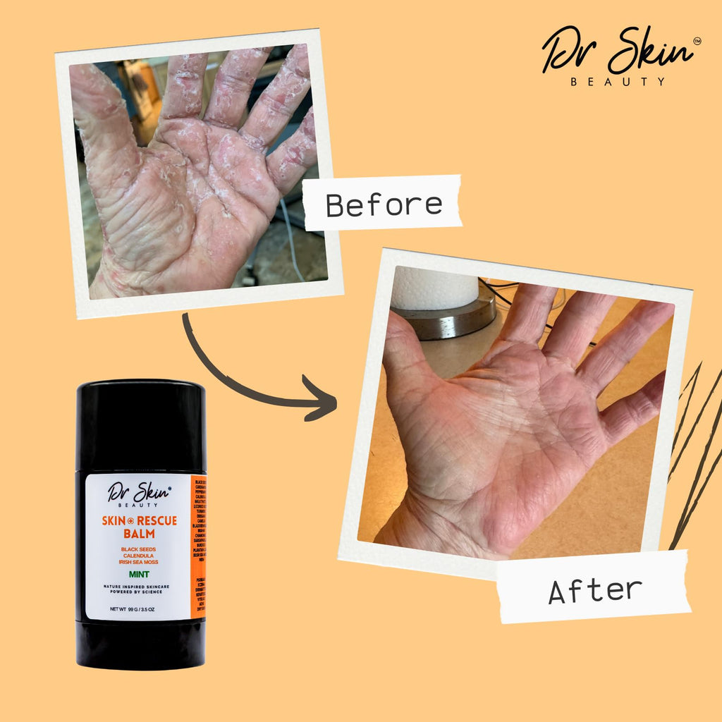 Dr. Skin Mint Rescue Balm - Plant Based Skin Moisturizer with 17+ Herbs Including Irish Sea Moss - Natural Recovery for Dry, Rough Areas - Repair Cracked Heels & Calms Irritation - 3.5oz