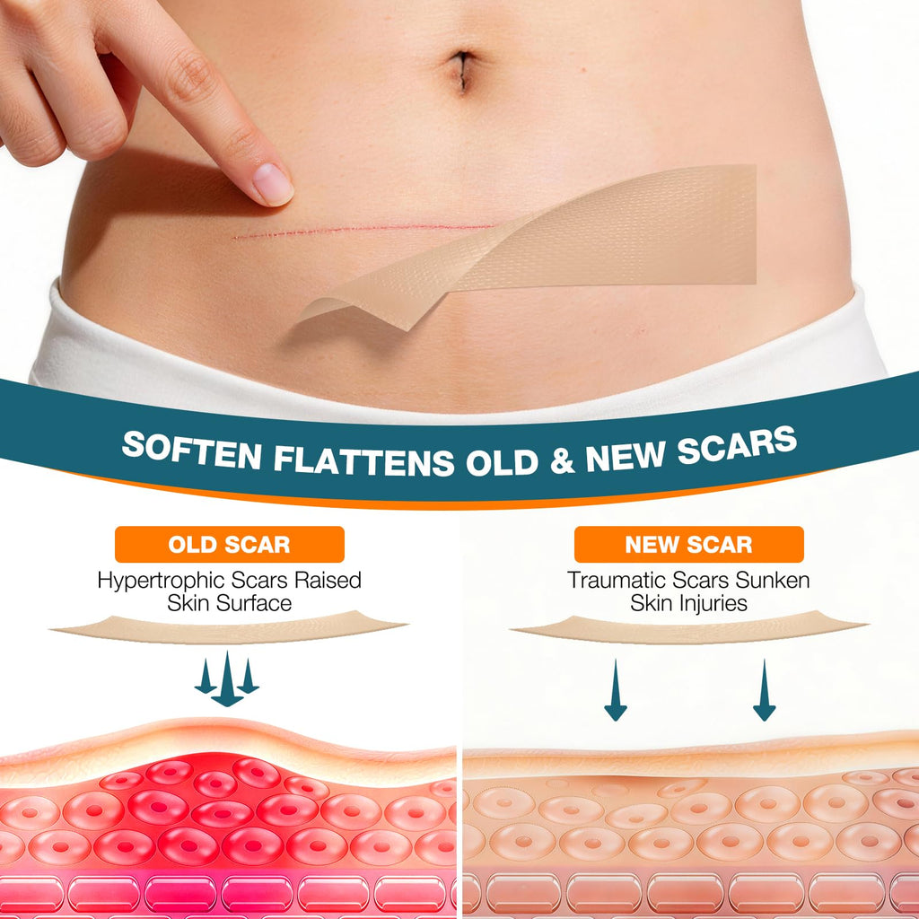 Silicone Scar Sheets,Silicone Scar Tape, Professional Scar Removal, Silicone Scar strips for Surgical scars tape, C-Section,Tummy Tuck (1.6x11859''Roll-3.0M) Keloid bump removal