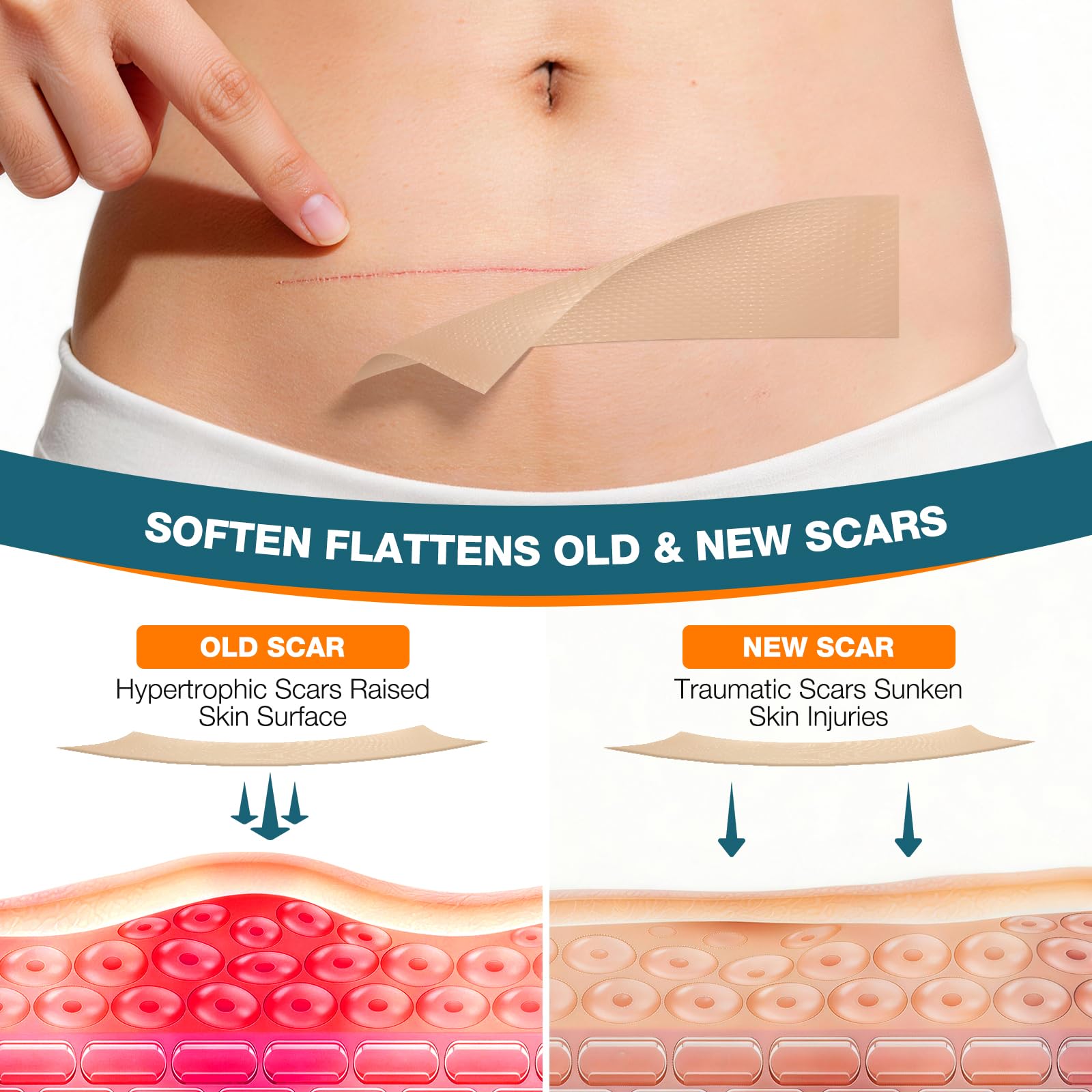 Silicone Scar Sheets,Silicone Scar Tape, Professional Scar Removal, Silicone Scar strips for Surgical scars tape, C-Section,Tummy Tuck (1.6x11859''Roll-3.0M) Keloid bump removal