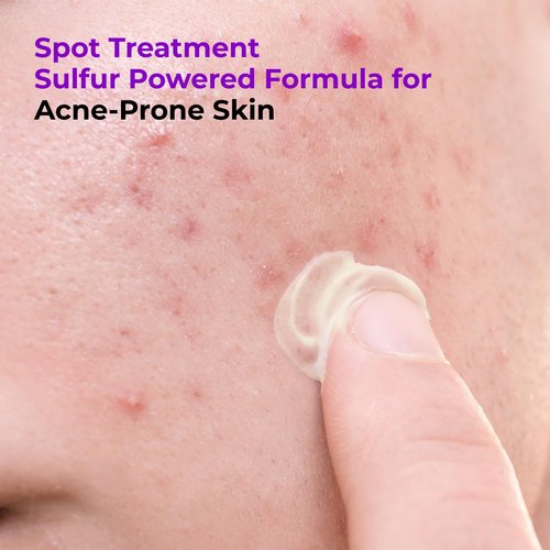 GLAM UP 10% Sulfur Treatment Serum - Fast Healing for Pimples & Acne Breakouts | 15mL (0.5 fl. oz.)