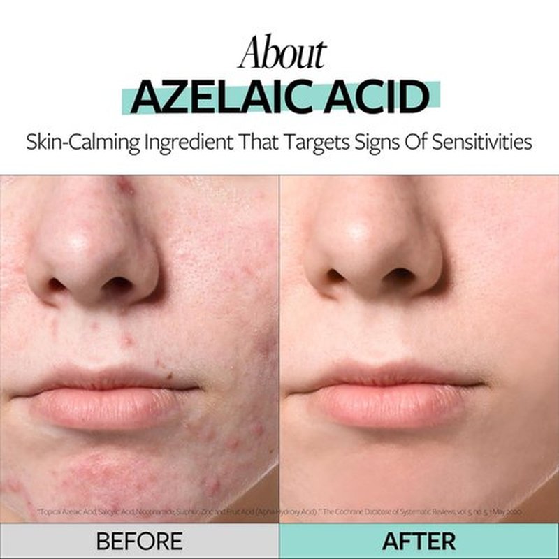 RECIPE Azelaic Acid 10 Soothing Ampoule - Gentle Facial Serum for Sensitive Skin | Korean Skincare (1.01 fl oz)