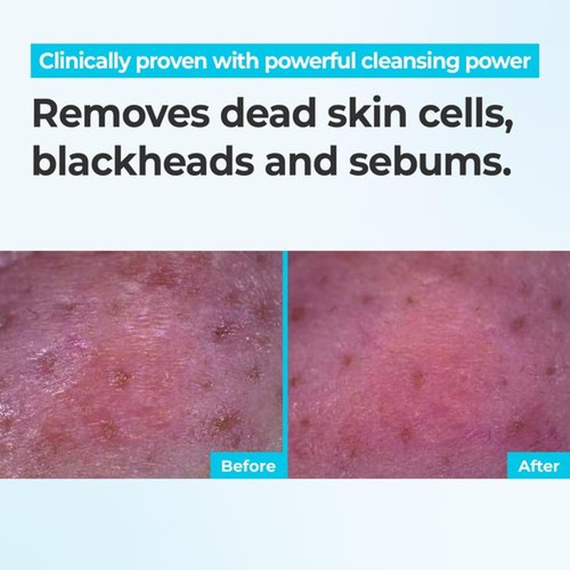 Rbfy. Bubble Clear Foaming Wash - Korean Daily Gentle Cleanser with Micro-Bubble | Salicylic Acid & Plant Extracts for Acne-Prone Skin, Deep Pore Cleaning & Exfoliation | Korean Skincare (5.24 fl oz)