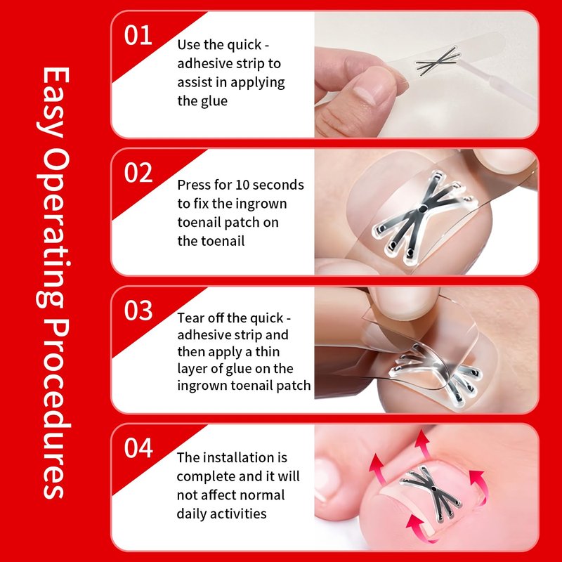 Upgraded Titanium Alloy Ingrown Toenail Corrector with Upgraded 6-Angle Shape,3x Stronger Pull Force,Ingrown Toenail Removal Kit, Ingrown Toenail Treatment for Women and Man (Small Size-6 packs)