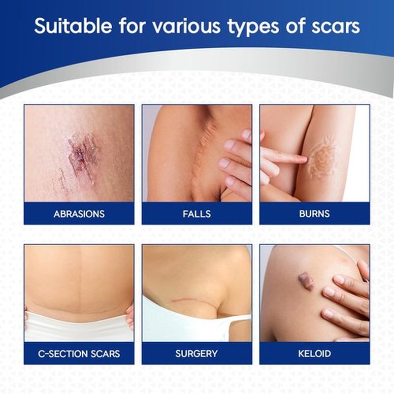 MURASAKI BEAUTY Silicone Scar Tape & Sheets – Removal on Keloids, Burns, Abrasion, C-Section, And Surgical Scars – Safe For Adults And Children – 1.6"X 60" Roll-4 X 1.5M(Pack of 1) (1.6X60inch)