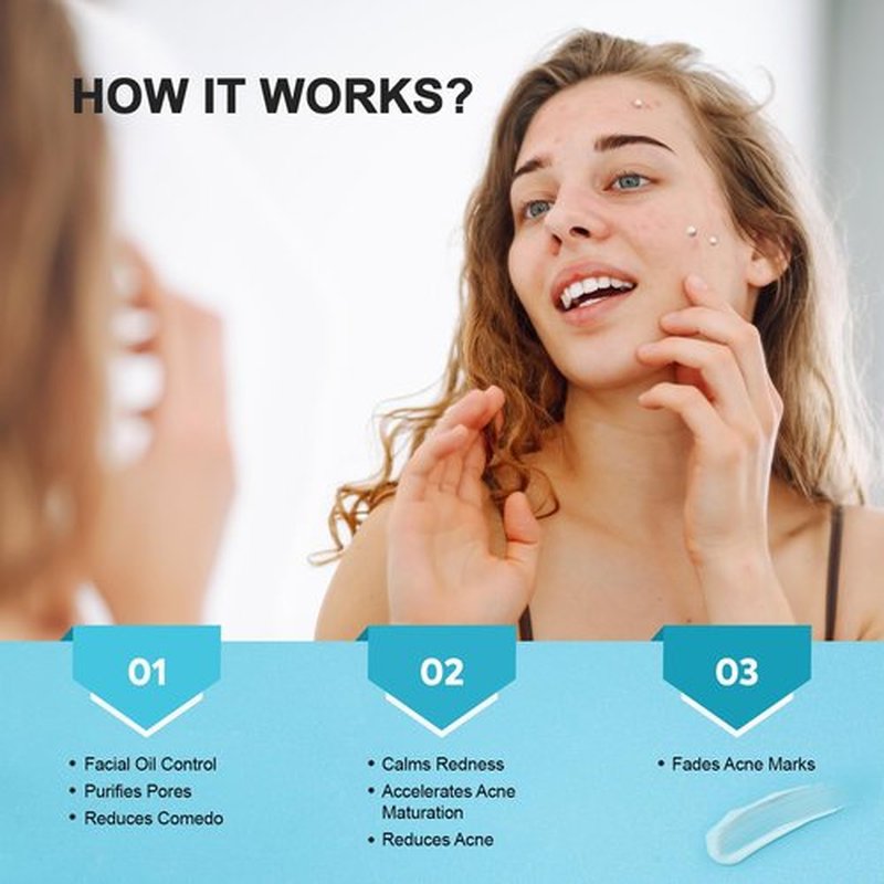 Acne Pimple Spot Treatment Cream: Cystic Hormonal Breakouts Control for Face & Back - 2% Salicylic Acid, Fast Redness Relief, Fades Blemishes & Post-Acne Marks, Teens-Adults, 1.8 oz