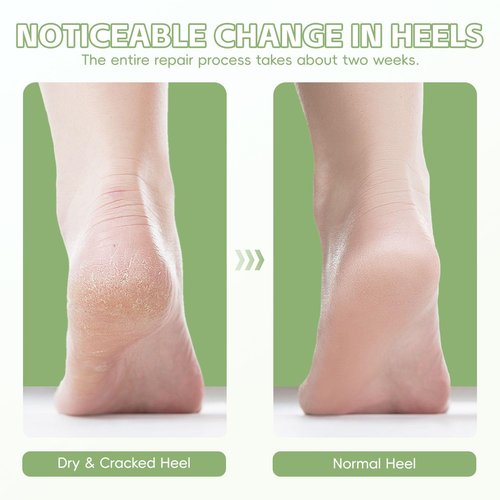 HATINXIA 2 Pairs Moisturizing Socks, Heel Socks for Cracked Heel Repair Treatment, Silicone Gel Toeless Socks, Foot Care Socks for Dry Cracked Feet Women, Lotion Moisture Pedicure Socks (Skin+Grey)