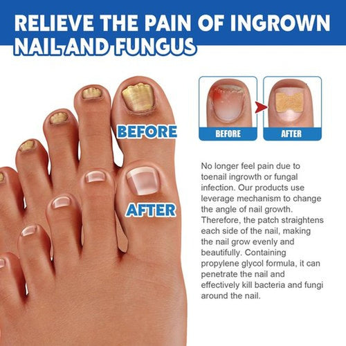 20 Patches Fungal Nail Repair for Toenail Restoration, Treats Thick, Damaged, Discolored or Falling Off Toenails, 8-Hour Intensive Treatment, Includes Nail Care Bandages