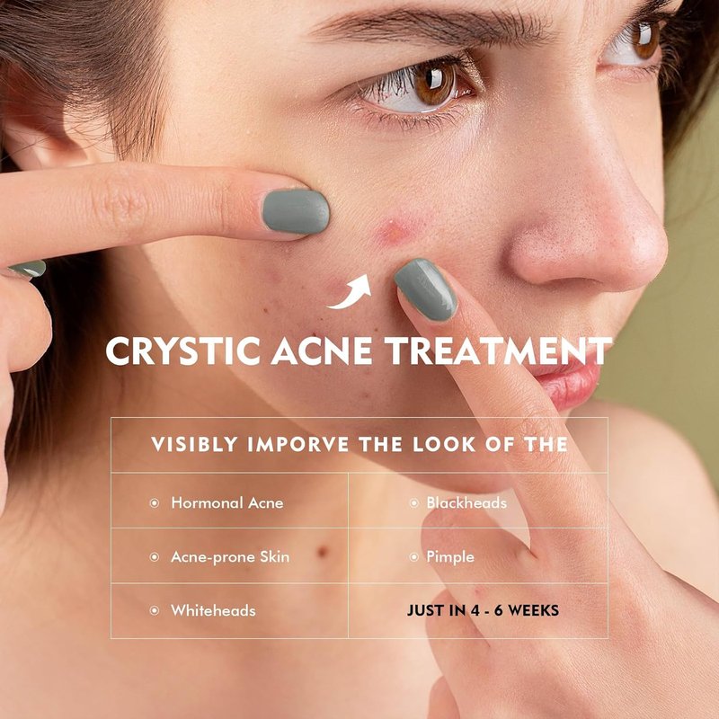 Azelaic Acid Serum by Regine Switzerland - Acne Treatment & Pore Refining Cream | 30ml for Sensitive Skin