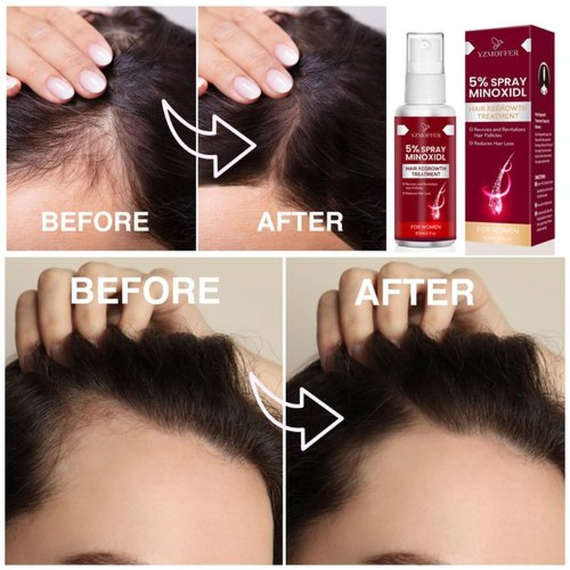 5% Minoxidil Spray for Women Hair Growth: Hair Regrowth Treatment for Thinning Hair and Hair Loss – Topical Extra Strength Treatment for Women – 60ML x 2 Pack